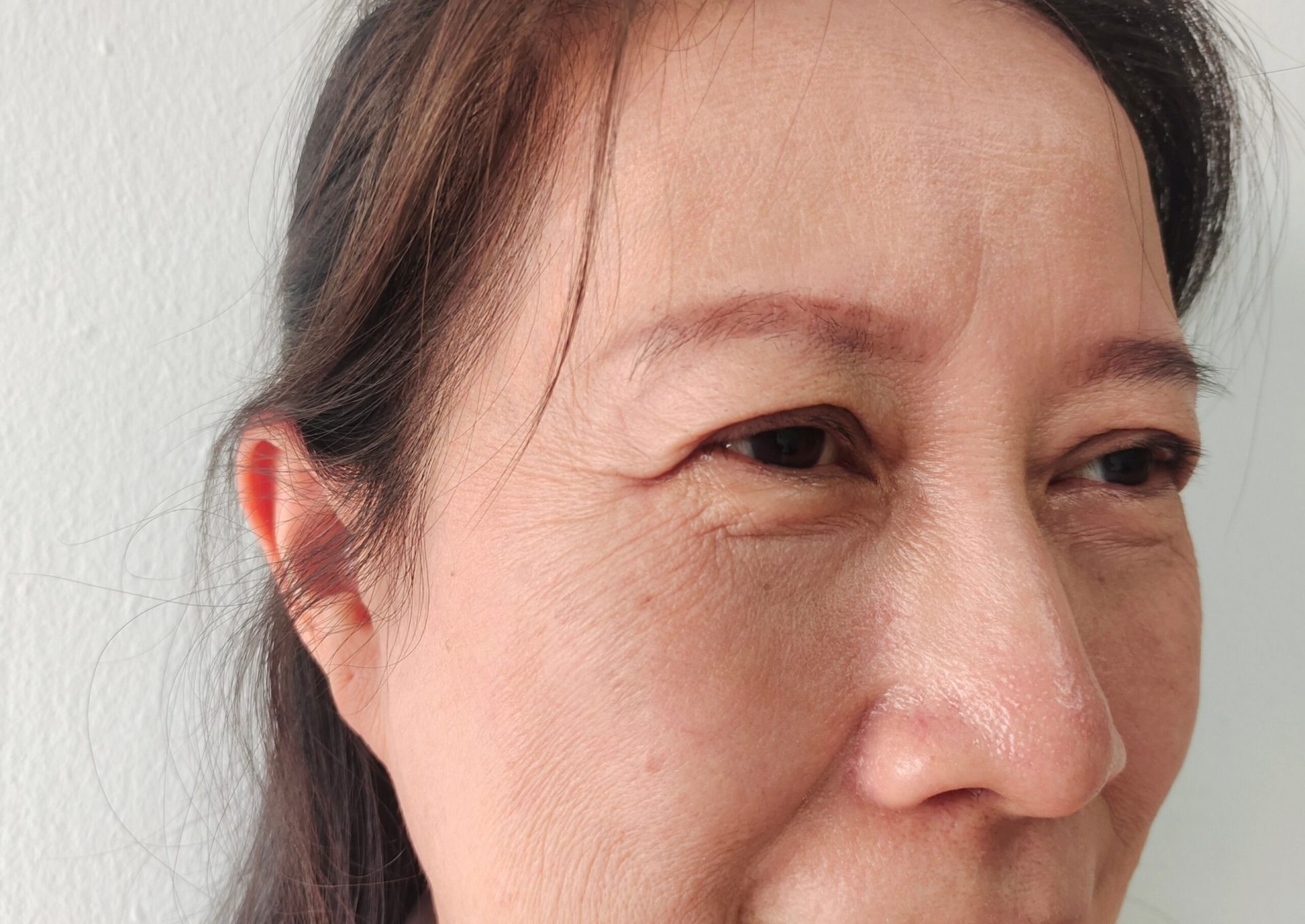 Upper Eyelid Ptosis