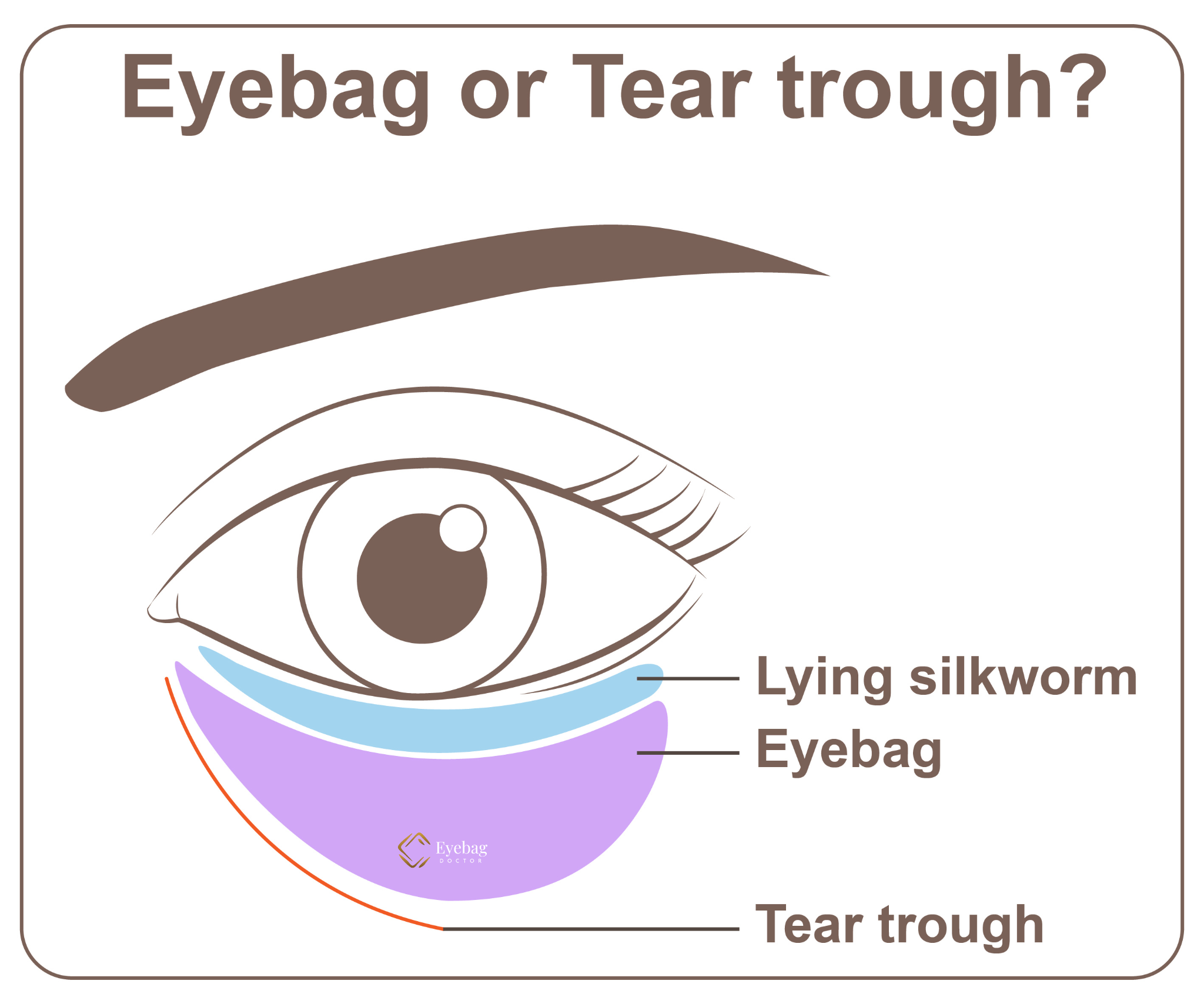 Eyebag Filler, Tear Trough